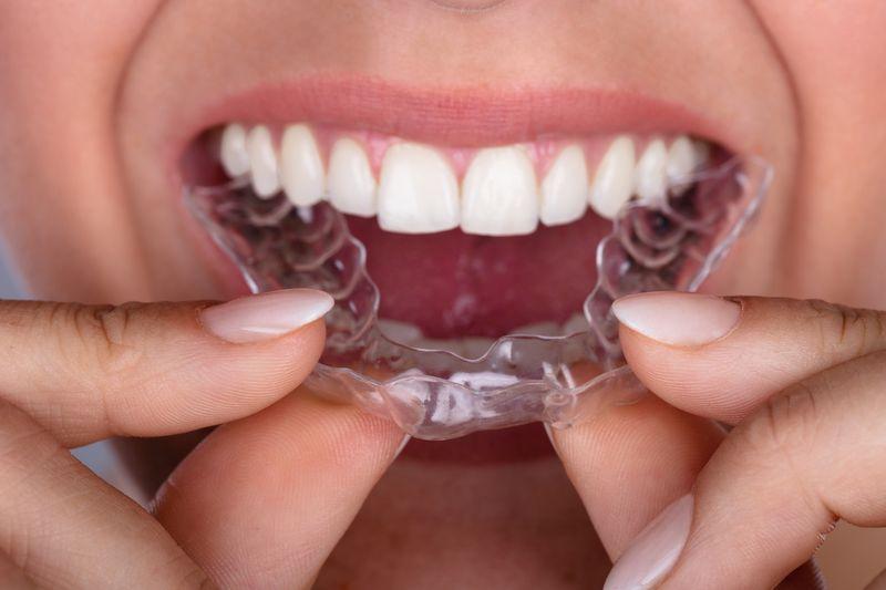 System prostowania zębów system Invisalign