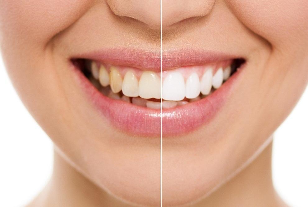 wybielanie zębów, przed i po